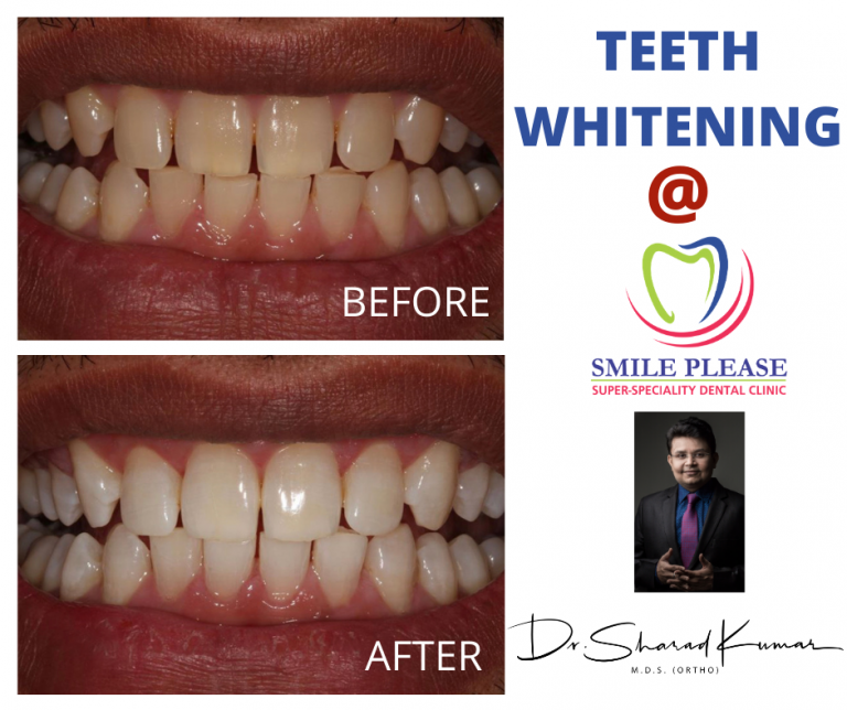 In office Teeth Whitening,Vashi |Navi Mumbai | Near me| Best Dental Clinic